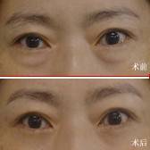 韩式泪感去眼袋