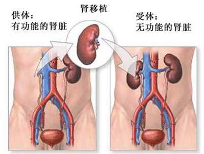 肾移植术后