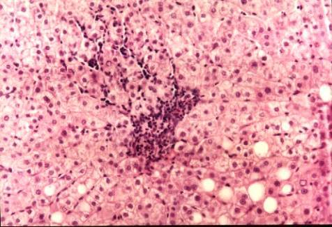 坏死(以酶溶性变化为特点的活体内局部组织细胞的死亡)