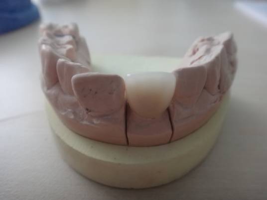 二氧化锆烤瓷牙