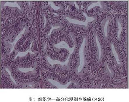宫颈腺癌（妇科疾病）
