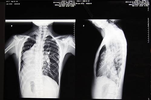 镜面人(医学术语)