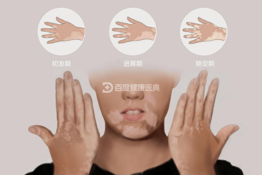 白癜风(医学疾病)