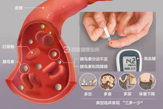 糖尿病（疾病名）