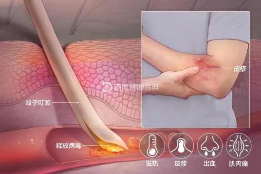 登革热(急性虫媒传染病)