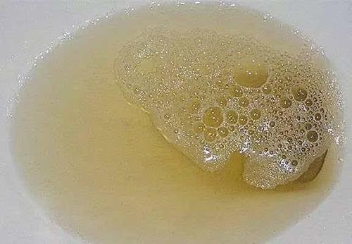 蛋白尿是什么样的呢？