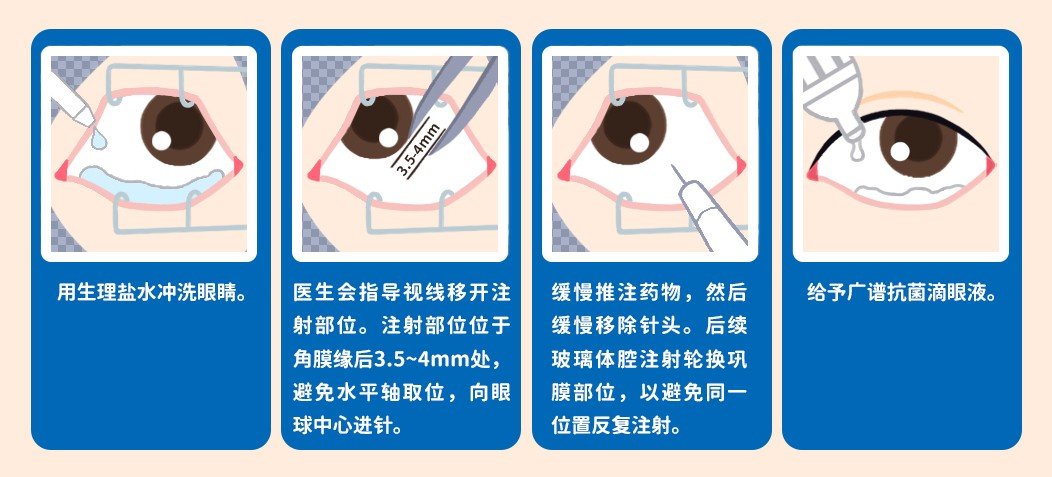 眼睛黄斑变性用什么方法治疗最好
