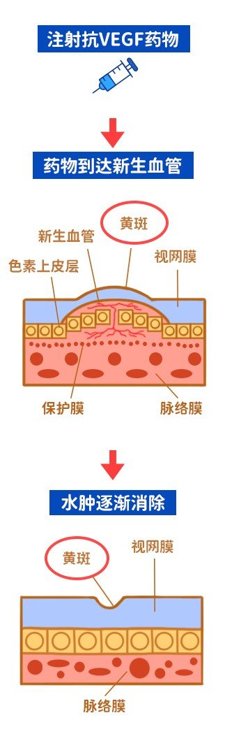 眼睛黄斑变性用什么方法治疗最好