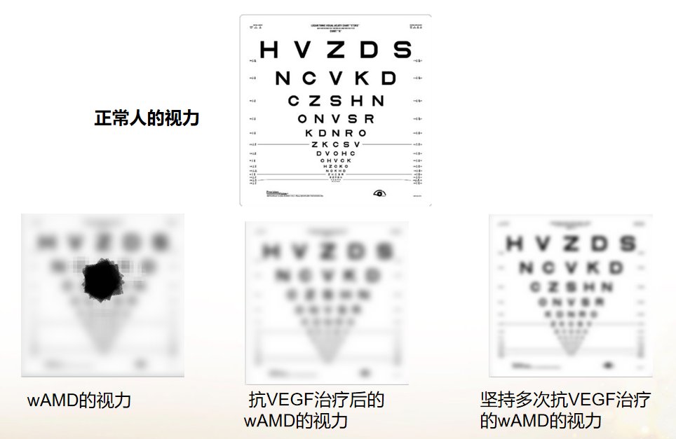 眼睛黄斑变性用什么方法治疗最好